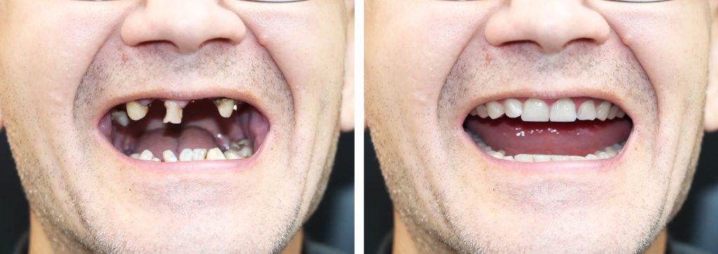 Before and after full mouth reconstruction