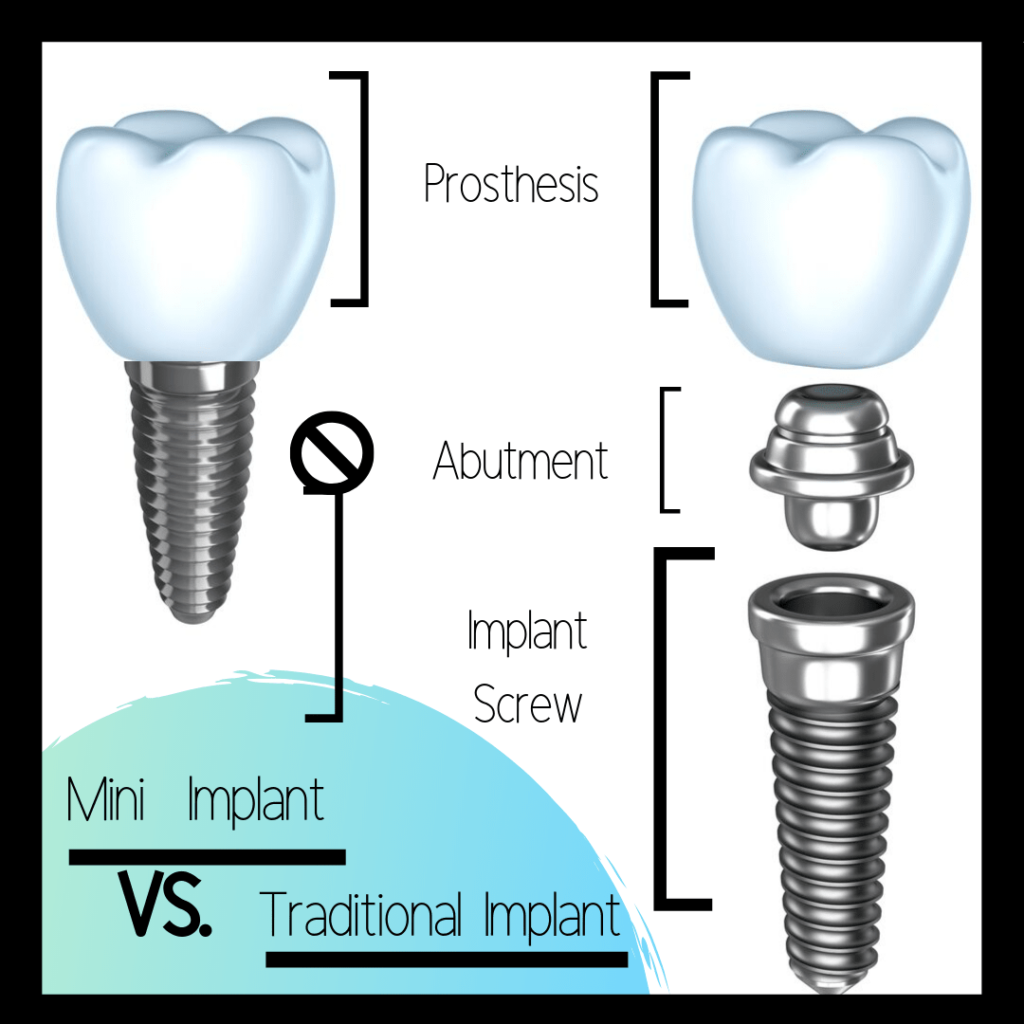 chart showing the differences between a mini/traditional dental implant
