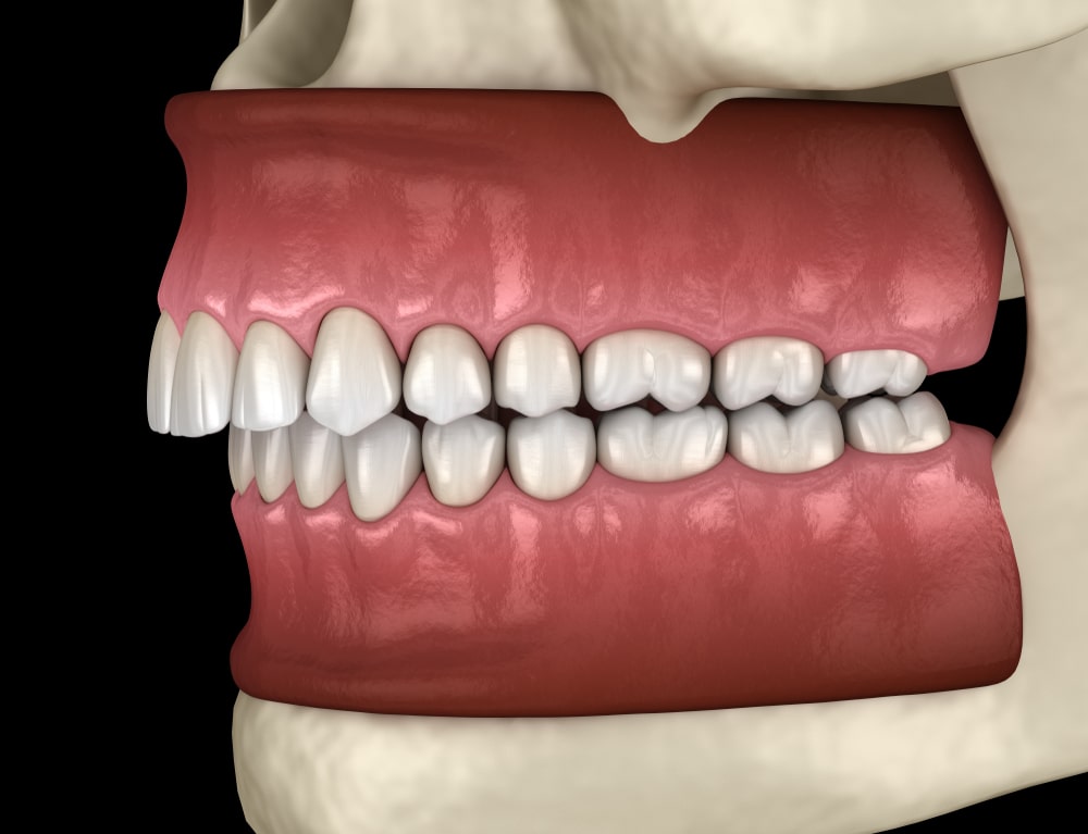 Computerized image of an overbite