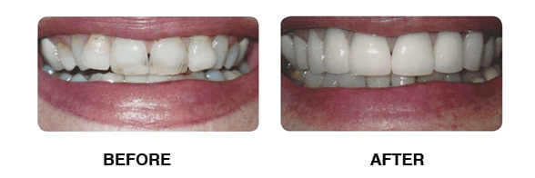 Dr Mancino Wall New Jersey Dentist, Before and After, Cosmetic Dentist NJ